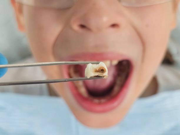 Best Emergency Root Canal Therapy in Cricket, NC